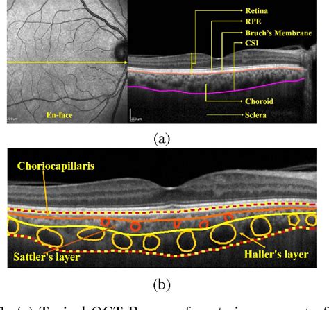 thickness of choroids